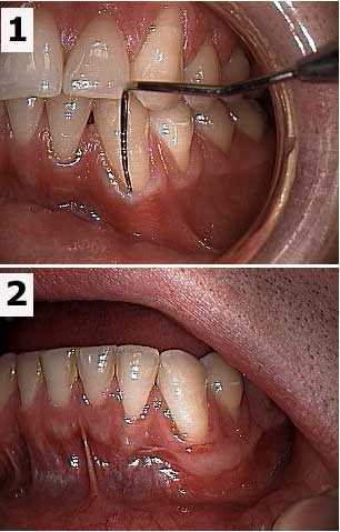 muco-gingival mucogingival graft surgery gum recession receded gum line gums healing photos