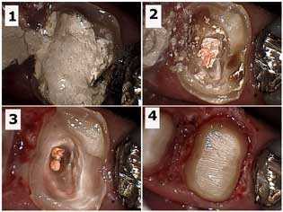 Gingivectomy, periodontal gum surgery, cutting gums, removal of gingival tissue electrosurgery