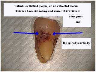 Plaque and Calculus, dental bacteria germs, periodontal gum disease gingival mouth odor smell 