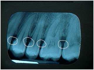 radiographic xray calculus plaque, gingivitis, gum disease, periodontitis, periodontal