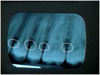 infection, plaque, calculus, gingivitis, gum disease, periodontitis, periodontal, x-ray, tooth pain