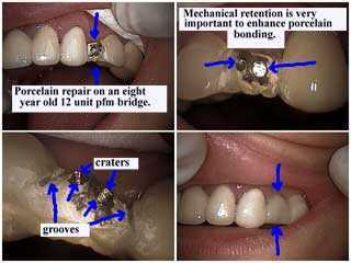 porcelain dental bridge repair fix caps broken crowns oral mouth