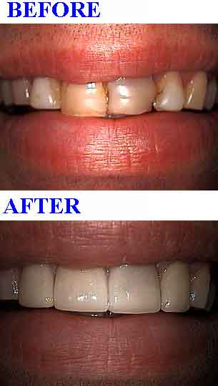 porcelain dental teeth veneers tooth laminates smile makeover aesthetic dentistry Lumineers