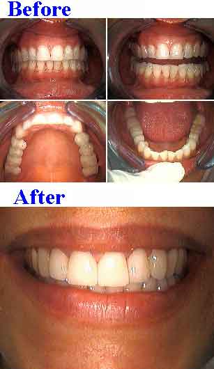 porcelain dental veneers teeth laminates tooth color shade white yellow cosmetic dentistry Dorfman
