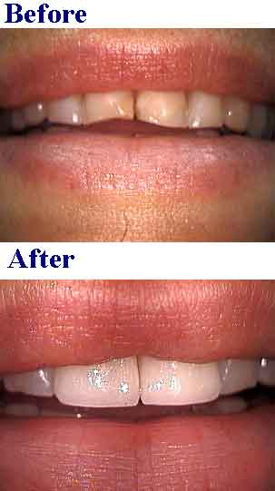 Porcelain veneers for short teeth, dental laminates lengthen broken tooth short veneer before and after