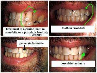 cross bite, porcelain veneer laminate, tooth, teeth, dental, cosmetic dentistry, crossbite