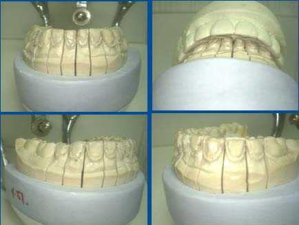 porcelain teeth veneers dental laminates tooth technique how to tooth preparation master model