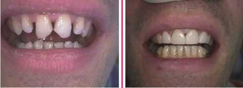 porcelain teeth veneers dental sculpting tooth reshaping incisal adjustment fangs