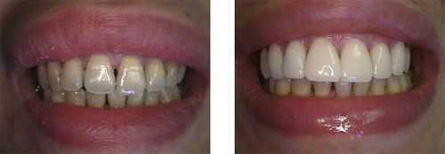 porcelain veneers, dental laminates, gray grey teeth color shade