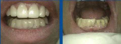Porcelain veneers dental laminates, temporary teeth provisional tooth Luxatemp photo