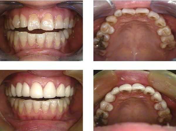 Porcelain veneers reshape the rotated teeth and offering lighter tooth color