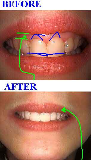 crown lengthening periodontal gum surgery, porcelain veneers teeth gummy smile gum line