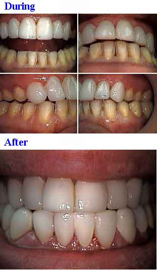 porcelain veneers teeth laminates dental tooth color shade Dr Dorfman smile makeover