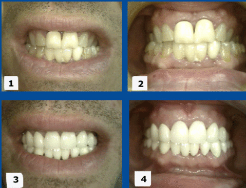 NY smile makeovers or esthetic dentistry treats cross-bite x-bite in this reconstruction