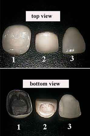porcelain veneers teeth laminates, porcelain dental crown caps jacket ceramic zirconium photos