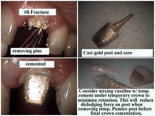 posts dental cores casting Post and Core, cast gold, cementation cement teeth tooth 
