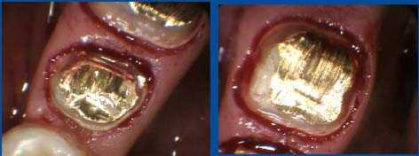 subgingival post and core, distal crown margins, crown lengthening periodontal flap surgery diagnosi