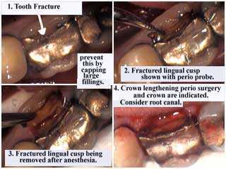 teeth caps crowns gums gingiva periodontics fracture of a large filling, vertical fractures