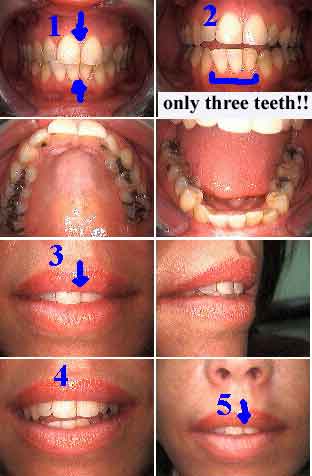 tooth midline deviation, asymmetry, smile facial face symmetry dental skeletal