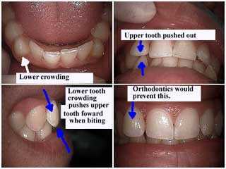 preventive interceptive Orthodontic theory how teeth braces dental movement orthodontists explain