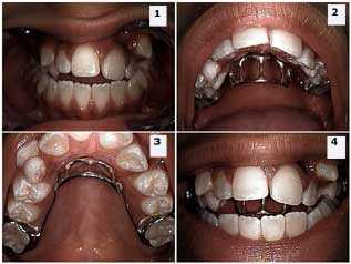 Orthodontics, Habits, Tongue-Thrust, Open Bite, Tongue Crib, anterior open bite closure