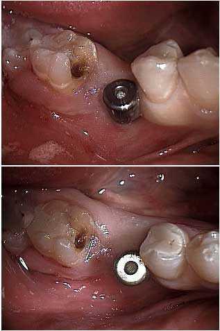 dental implants problem, artificial tooth root complications failure prosthetics site placement