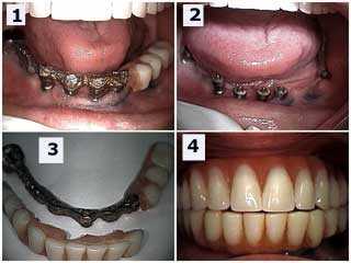 dental implants complications failure, prosthetics, broken acrylic prosthesis, repair fix dental bri
