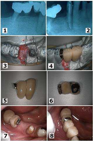 Dental Semi-precision Attachment, pontic, Metal Framework, Radiograph distal root caries