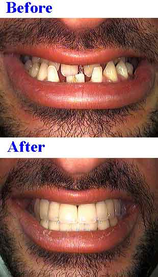 Full mouth reconstruction underbite class 3 three prognathic bridges, fixed caps, dental crown, porcelain metal, pfm