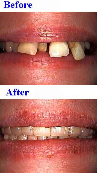 Provisional full arch Bridges, lab processed acrylic teeth, smile makeover plastic