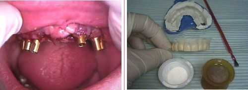 provisional temporary dental bridge dental implants parallelism how to pictures teeth