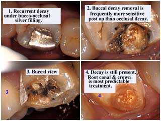 tooth decay crown caps recurrent big tooth cavity buccal dental caries sensitive occlusal