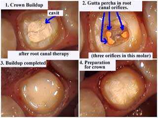 dental crown caps technique drilling tooth preparation after root canal therapy buildup teeth drill