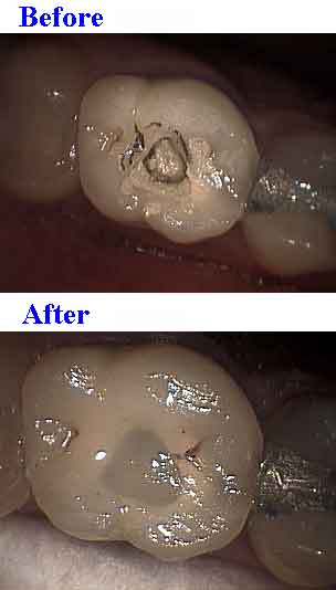 teeth crown buildup bonding core composite crown cap access silane primer porcelain etch