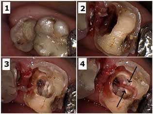 Pulpotomy pulpitis dental tooth nerve treatment symptoms pain pulp sedative root canal endodontics