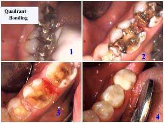 quadrant bonding, teeth, dental, procedure, composite resin white tooth fillings 