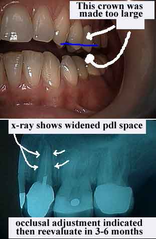 radiograph dental x-ray, xray, gums, gingiva, traumatic occlusion occlusal trauma fremitus