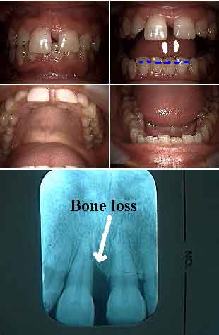 radiograph dental x-ray xray tooth periodontal gums teeth bite problems occlusion