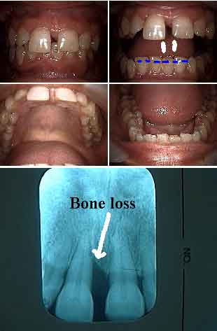 Mobility, tooth teeth, fremitus, loose mobile, combined occluso-periodontal disease 