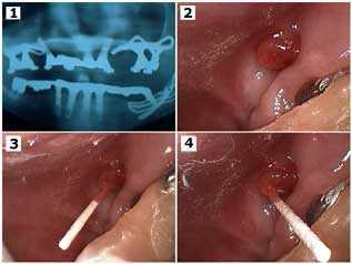 radiograph unilateral subperiosteal dental implant xray x-ray x-rays, xrays, Culture Fistula Absces