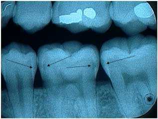Radiographic Tooth Decay Interproximal Teeth Cavity X-ray xrays diagnosis interpretation diagnose