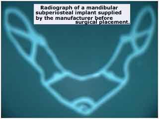 Radiographic, x-ray, xray, subperiosteal implant dental implantology occlusal view alternative