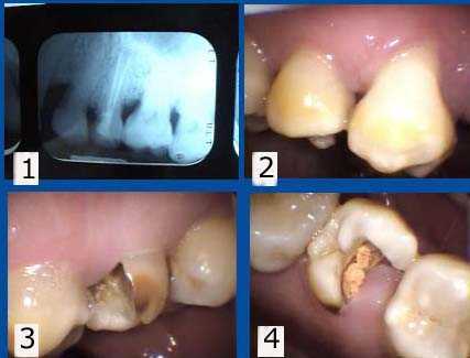 early cavity xray