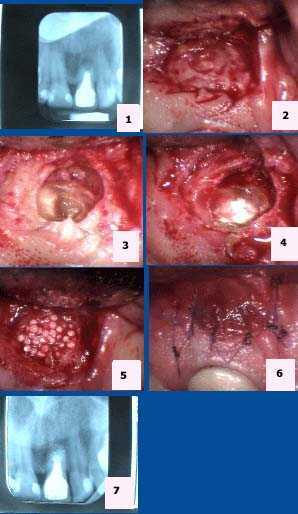 apicoectomy, root canal apical gum oral surgery, MTA, Mineral Trioxide Aggregate, HTR