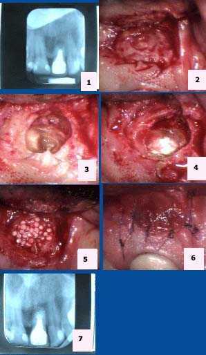 radiographic,periapical pathology, endodontics, x-ray, root canal, xray dental tooth apicoectomy or