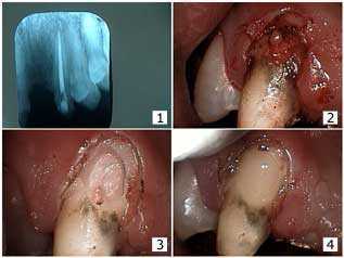 gingivectomy Dental Bridge Repair Resorption Gum Surgery Electrosurgery Gingival Margin gv Root