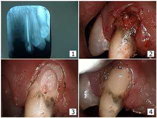 recurrent caries, teeth decay, dental cavities Bridge Repair Resorption Gingival Margin Gingivecto