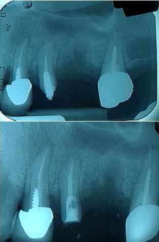 endodontics obturation root canal filling, lateral vertical condensation, retreatment x-rays xray