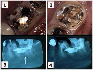 tooth pain calcification teeth calcified endodontics root canal therapy cleaning shaping