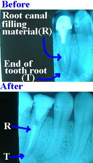 endodontics, root canal, retreatment, failure incomplete inadequate x-ray instrumentation obturation